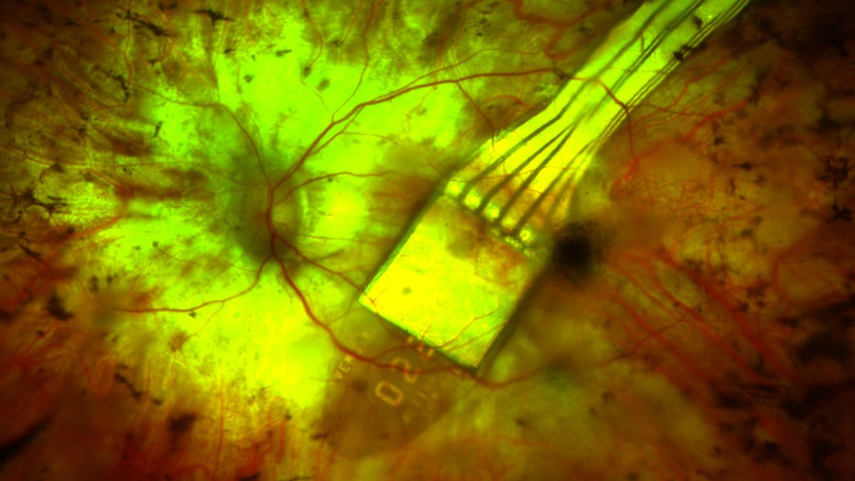 A 2-Millimeter Chip Let a Stargardt Patient Read a Word: Science Corporation Implants the First Trial Patient With Its Vision-Restoring PRIMA Device
